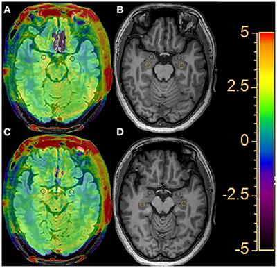 Amide Proton Transfer-Weighted MRI Might Help Distinguish Amnestic Mild Cognitive Impairment From a Normal Elderly Population